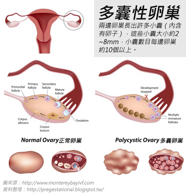 多囊性卵巢會有超過10個以上約2~8mm的小囊