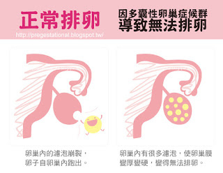 多囊性卵巢症候群無法自行排卵