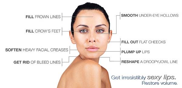 medspa-restylane