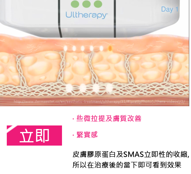 超音波拉皮Ulthera極線音波拉皮極限音波拉皮筋膜拉皮超音波拉皮電波拉皮02 超音波拉皮Ulthera極線音波拉皮極限音波拉皮筋膜拉皮超音波拉皮電波拉皮02