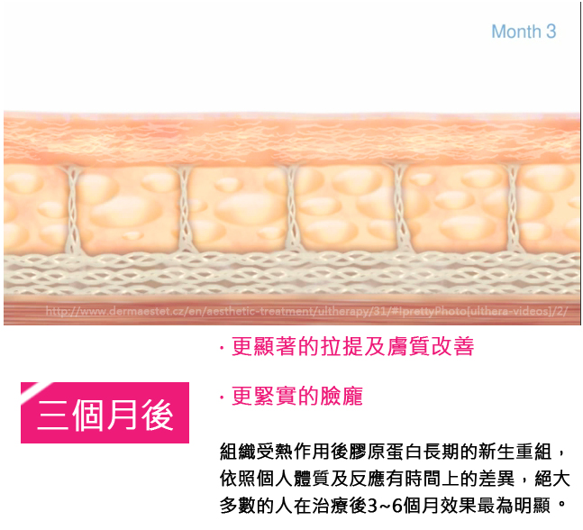 超音波拉皮Ulthera極線音波拉皮極限音波拉皮筋膜拉皮超音波拉皮電波拉皮01 超音波拉皮Ulthera極線音波拉皮極限音波拉皮筋膜拉皮超音波拉皮電波拉皮01