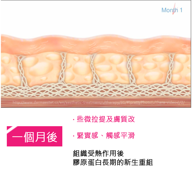 超音波拉皮Ulthera極線音波拉皮極限音波拉皮筋膜拉皮超音波拉皮電波拉皮03