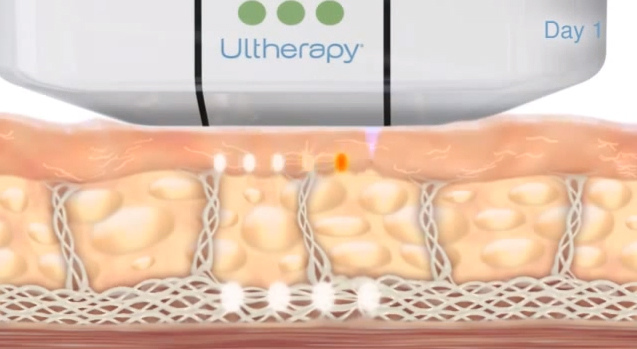 低頭族手機成癮智慧型手機雙下巴臉頰鬆垮Ultherapy極限音波拉皮液態拉皮09.jpg 低頭族手機成癮智慧型手機雙下巴臉頰鬆垮Ultherapy極限音波拉皮液態拉皮09.jpg