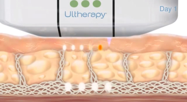 低頭族手機成癮智慧型手機雙下巴臉頰鬆垮Ultherapy極限音波拉皮液態拉皮09.jpg