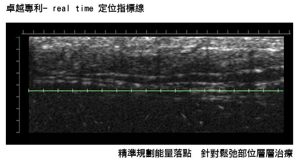 低頭族手機成癮智慧型手機雙下巴臉頰鬆垮Ultherapy極限音波拉皮液態拉皮14.jpg 低頭族手機成癮智慧型手機雙下巴臉頰鬆垮Ultherapy極限音波拉皮液態拉皮14.jpg