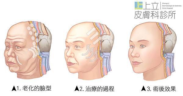 林上立 推薦 液態拉皮 推薦 舒顏萃 推薦 3D聚左旋乳酸 推薦 上立提 推薦 SCULPTRA 推薦 林上立 液態拉皮 推薦 童顏針 林上立 推薦 童顏針 推薦 液態拉皮上立提19