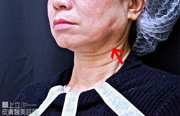上立皮膚科 費用 林上立 價格 林上立 評價 林上立 超音波拉皮 超音波拉皮 費用 超音波拉皮 價格 超音波拉皮 會不會痛 液態拉皮上立提 液態拉皮 推薦 微晶瓷 推薦 微晶瓷 下巴 微晶瓷拉提 推薦 Ulthera™ 極線音波拉皮 極限音波拉皮 筋膜拉皮04.jpg 上立皮膚科 費用 林上立 價格 林上立 評價 林上立 超音波拉皮 超音波拉皮 費用 超音波拉皮 價格 超音波拉皮 會不會痛 液態拉皮上立提 液態拉皮 推薦 微晶瓷 推薦 微晶瓷 下巴 微晶瓷拉提 推薦 Ulthera™ 極線音波拉皮 極限音波拉皮 筋膜拉皮04.jpg
