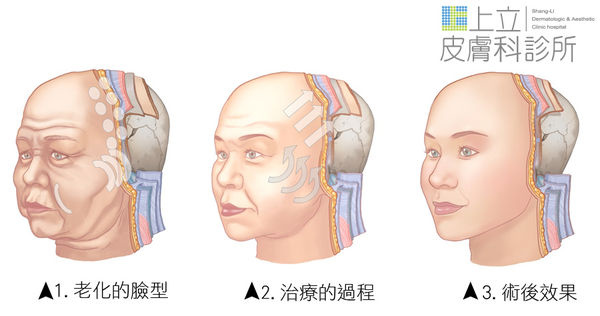 Ulthera™ 極線音波拉皮 極限音波拉皮 筋膜拉皮 超音波拉皮 價格 極限音波拉皮 價格 極限音波拉皮 費用 超音波拉皮 價格 超音波拉皮 費用 液態拉皮上立提 推薦 林上立 推薦 林上立皮膚科06.jpg