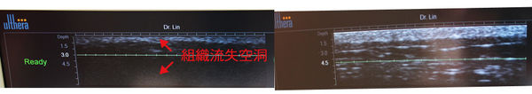 超音波拉皮極線音波拉皮超音波拉皮費用音波拉皮價格05.jpg 超音波拉皮極線音波拉皮超音波拉皮費用音波拉皮價格05.jpg