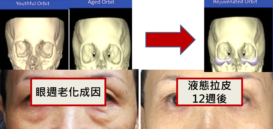 超音波拉皮極線音波拉皮超音波拉皮費用音波拉皮價格09.jpg 超音波拉皮極線音波拉皮超音波拉皮費用音波拉皮價格09.jpg