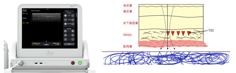 超音波拉皮推薦極線音波拉提筋膜拉皮超音波拉皮費用價格多少錢04