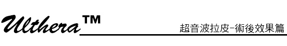 林上立 推薦 液態拉皮 推薦 極線音波拉皮 推薦 極限音波拉皮 推薦 筋膜拉皮 推薦 超音波拉皮 推薦 超音波拉皮 推薦Ulthera超音波拉皮極線音波拉提筋膜拉皮超音波拉皮價格推薦醫師鬆弛下垂法令紋嘴邊肉林上立醫師上立皮膚科18 林上立 推薦 液態拉皮 推薦 極線音波拉皮 推薦 極限音波拉皮 推薦 筋膜拉皮 推薦 超音波拉皮 推薦 超音波拉皮 推薦Ulthera超音波拉皮極線音波拉提筋膜拉皮超音波拉皮價格推薦醫師鬆弛下垂法令紋嘴邊肉林上立醫師上立皮膚科18