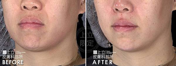 林上立 推薦 液態拉皮 推薦 極線音波拉皮 推薦 極限音波拉皮 推薦 筋膜拉皮 推薦 超音波拉皮 推薦 超音波拉皮 推薦Ulthera超音波拉皮極線音波拉提筋膜拉皮超音波拉皮價格推薦醫師鬆弛下垂法令紋嘴邊肉林上立醫師上立皮膚科03 林上立 推薦 液態拉皮 推薦 極線音波拉皮 推薦 極限音波拉皮 推薦 筋膜拉皮 推薦 超音波拉皮 推薦 超音波拉皮 推薦Ulthera超音波拉皮極線音波拉提筋膜拉皮超音波拉皮價格推薦醫師鬆弛下垂法令紋嘴邊肉林上立醫師上立皮膚科03