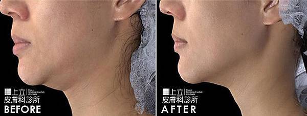 林上立 推薦 液態拉皮 推薦 極線音波拉皮 推薦 極限音波拉皮 推薦 筋膜拉皮 推薦 超音波拉皮 推薦 超音波拉皮 推薦Ulthera超音波拉皮極線音波拉提筋膜拉皮超音波拉皮價格推薦醫師鬆弛下垂法令紋嘴邊肉林上立醫師上立皮膚科02 林上立 推薦 液態拉皮 推薦 極線音波拉皮 推薦 極限音波拉皮 推薦 筋膜拉皮 推薦 超音波拉皮 推薦 超音波拉皮 推薦Ulthera超音波拉皮極線音波拉提筋膜拉皮超音波拉皮價格推薦醫師鬆弛下垂法令紋嘴邊肉林上立醫師上立皮膚科02