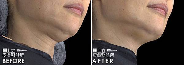 林上立 推薦 液態拉皮 推薦 極線音波拉皮 推薦 極限音波拉皮 推薦 筋膜拉皮 推薦 超音波拉皮 推薦 超音波拉皮 推薦Ulthera超音波拉皮極線音波拉提筋膜拉皮超音波拉皮價格推薦醫師鬆弛下垂法令紋嘴邊肉林上立醫師上立皮膚科 林上立 推薦 液態拉皮 推薦 極線音波拉皮 推薦 極限音波拉皮 推薦 筋膜拉皮 推薦 超音波拉皮 推薦 超音波拉皮 推薦Ulthera超音波拉皮極線音波拉提筋膜拉皮超音波拉皮價格推薦醫師鬆弛下垂法令紋嘴邊肉林上立醫師上立皮膚科