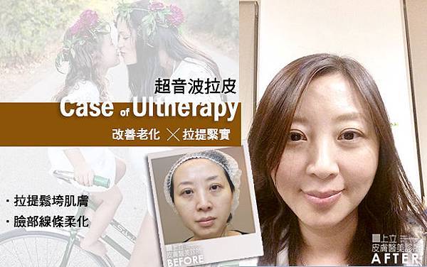 上立皮膚科 費用 林上立 價格 林上立 評價 林上立 超音波拉皮 超音波拉皮 費用 超音波拉皮 價格 超音波拉皮 會不會痛 Ulthera™ 極線音波拉皮 極限音波拉皮 筋膜拉皮.jpg 上立皮膚科 費用 林上立 價格 林上立 評價 林上立 超音波拉皮 超音波拉皮 費用 超音波拉皮 價格 超音波拉皮 會不會痛 Ulthera™ 極線音波拉皮 極限音波拉皮 筋膜拉皮.jpg