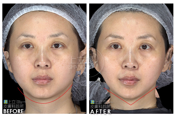 上立皮膚科 費用 林上立 價格 林上立 評價 林上立 超音波拉皮 超音波拉皮 費用 超音波拉皮 價格 超音波拉皮 會不會痛 Ulthera™ 極線音波拉皮 極限音波拉皮 筋膜拉皮07 上立皮膚科 費用 林上立 價格 林上立 評價 林上立 超音波拉皮 超音波拉皮 費用 超音波拉皮 價格 超音波拉皮 會不會痛 Ulthera™ 極線音波拉皮 極限音波拉皮 筋膜拉皮07