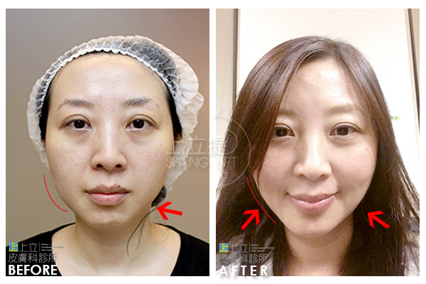 上立皮膚科 費用 林上立 價格 林上立 評價 林上立 超音波拉皮 超音波拉皮 費用 超音波拉皮 價格 超音波拉皮 會不會痛 Ulthera™ 極線音波拉皮 極限音波拉皮 筋膜拉皮06 上立皮膚科 費用 林上立 價格 林上立 評價 林上立 超音波拉皮 超音波拉皮 費用 超音波拉皮 價格 超音波拉皮 會不會痛 Ulthera™ 極線音波拉皮 極限音波拉皮 筋膜拉皮06