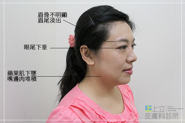 上立皮膚科 費用 林上立 價格 林上立 評價 液態拉皮上立提 液態拉皮 推薦液態拉皮晶亮瓷微晶瓷晶亮瓷推薦晶亮瓷價格晶亮瓷術後晶亮瓷隆鼻晶亮瓷墊下巴微晶瓷隆鼻09.jpg 上立皮膚科 費用 林上立 價格 林上立 評價 液態拉皮上立提 液態拉皮 推薦液態拉皮晶亮瓷微晶瓷晶亮瓷推薦晶亮瓷價格晶亮瓷術後晶亮瓷隆鼻晶亮瓷墊下巴微晶瓷隆鼻09.jpg