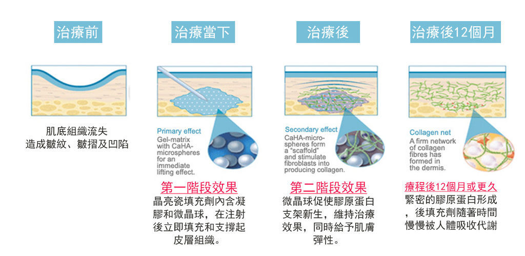 晶亮瓷微晶瓷隆鼻墊下巴晶亮瓷拉提液態拉皮.jpg