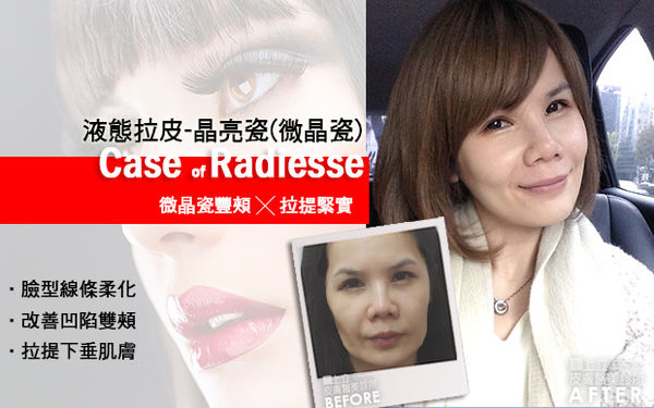 極線音波拉皮 推薦 極限音波拉皮 推薦 筋膜拉皮 推薦 超音波拉皮 推薦 超音波拉皮 推薦Ulthera超音波拉皮極線音波拉提筋膜拉皮超音波拉皮價格推薦鬆弛下垂法令紋嘴邊肉液態拉皮上立提3D聚左旋乳酸 舒顏萃 童顏針 液態拉皮 推薦 Sculptra液態拉皮3D聚左旋乳酸晶亮瓷微晶瓷晶亮瓷推薦晶亮瓷價格晶亮瓷術後05.jpg 極線音波拉皮 推薦 極限音波拉皮 推薦 筋膜拉皮 推薦 超音波拉皮 推薦 超音波拉皮 推薦Ulthera超音波拉皮極線音波拉提筋膜拉皮超音波拉皮價格推薦鬆弛下垂法令紋嘴邊肉液態拉皮上立提3D聚左旋乳酸 舒顏萃 童顏針 液態拉皮 推薦 Sculptra液態拉皮3D聚左旋乳酸晶亮瓷微晶瓷晶亮瓷推薦晶亮瓷價格晶亮瓷術後05.jpg