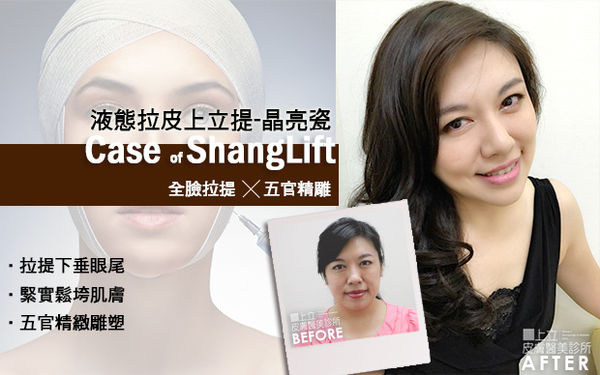 極線音波拉皮 推薦 極限音波拉皮 推薦 筋膜拉皮 推薦 超音波拉皮 推薦 超音波拉皮 推薦Ulthera超音波拉皮極線音波拉提筋膜拉皮超音波拉皮價格推薦鬆弛下垂法令紋嘴邊肉液態拉皮上立提3D聚左旋乳酸 舒顏萃 童顏針 液態拉皮 推薦 Sculptra液態拉皮3D聚左旋乳酸晶亮瓷微晶瓷晶亮瓷推薦晶亮瓷價格晶亮瓷術後03.jpg 極線音波拉皮 推薦 極限音波拉皮 推薦 筋膜拉皮 推薦 超音波拉皮 推薦 超音波拉皮 推薦Ulthera超音波拉皮極線音波拉提筋膜拉皮超音波拉皮價格推薦鬆弛下垂法令紋嘴邊肉液態拉皮上立提3D聚左旋乳酸 舒顏萃 童顏針 液態拉皮 推薦 Sculptra液態拉皮3D聚左旋乳酸晶亮瓷微晶瓷晶亮瓷推薦晶亮瓷價格晶亮瓷術後03.jpg