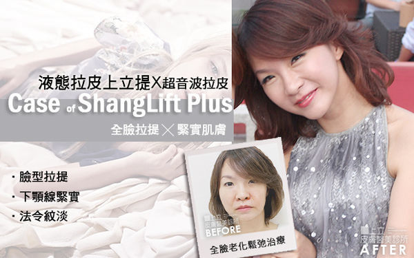 極線音波拉皮 推薦 極限音波拉皮 推薦 筋膜拉皮 推薦 超音波拉皮 推薦 超音波拉皮 推薦Ulthera超音波拉皮極線音波拉提筋膜拉皮超音波拉皮價格推薦鬆弛下垂法令紋嘴邊肉液態拉皮上立提3D聚左旋乳酸 舒顏萃 童顏針 液態拉皮 推薦 Sculptra液態拉皮3D聚左旋乳酸晶亮瓷微晶瓷晶亮瓷推薦晶亮瓷價格晶亮瓷術後08.jpg 極線音波拉皮 推薦 極限音波拉皮 推薦 筋膜拉皮 推薦 超音波拉皮 推薦 超音波拉皮 推薦Ulthera超音波拉皮極線音波拉提筋膜拉皮超音波拉皮價格推薦鬆弛下垂法令紋嘴邊肉液態拉皮上立提3D聚左旋乳酸 舒顏萃 童顏針 液態拉皮 推薦 Sculptra液態拉皮3D聚左旋乳酸晶亮瓷微晶瓷晶亮瓷推薦晶亮瓷價格晶亮瓷術後08.jpg