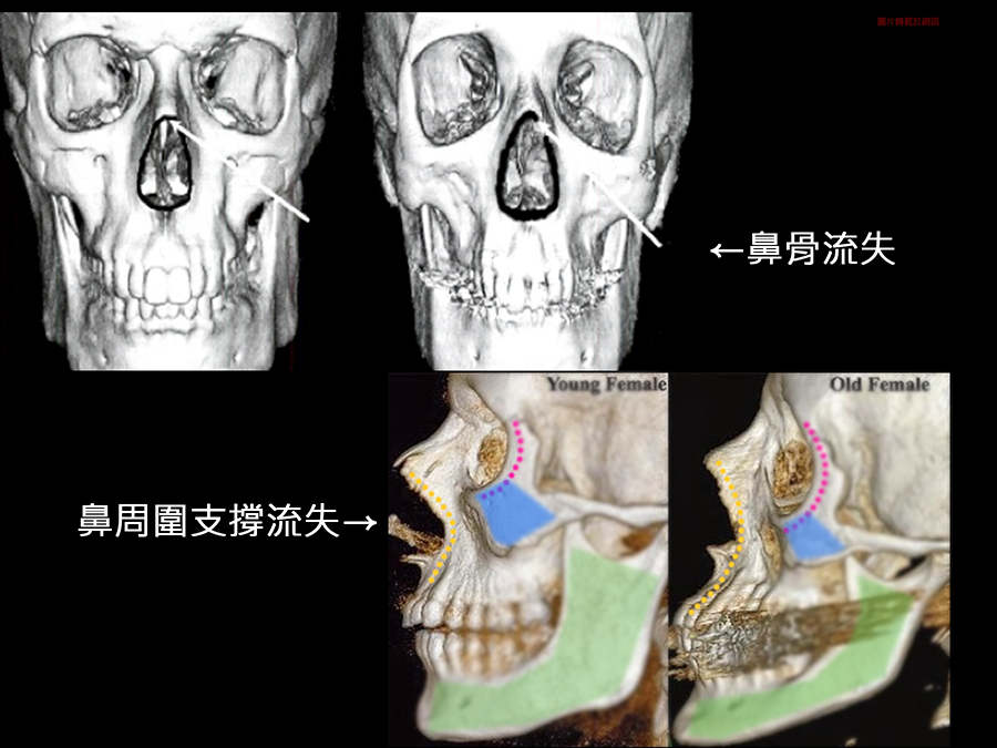 晶亮瓷微晶瓷晶亮瓷隆鼻墊晶亮瓷下巴豐額晶亮瓷價格晶亮瓷玻尿酸波酸豐唇晶亮瓷價位晶亮瓷醫師推薦03