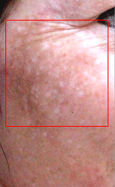 PicoSure蜂巢皮秒除皺雷射 除皺雷射 蜂巢皮秒機械光755雷射 淨膚雷射蜂巢瞬效透鏡 蜂巢皮秒機械光雷射PicoSure皮秒雷射雀斑曬斑 細紋眼下細紋毛孔粗大飛梭雷射縮毛孔淨膚雷射皮秒雷射價格皮秒雷射價錢皮秒雷射凹洞皮秒雷射除斑皮秒雷射刺青02.png PicoSure蜂巢皮秒除皺雷射 除皺雷射 蜂巢皮秒機械光755雷射 淨膚雷射蜂巢瞬效透鏡 蜂巢皮秒機械光雷射PicoSure皮秒雷射雀斑曬斑 細紋眼下細紋毛孔粗大飛梭雷射縮毛孔淨膚雷射皮秒雷射價格皮秒雷射價錢皮秒雷射凹洞皮秒雷射除斑皮秒雷射刺青02.png