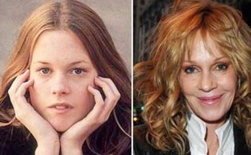 新Ellansé 洢蓮絲少女針PolycaprolactonePCL膠原增生劑洢蓮絲上立皮膚科林上立洢蓮絲3D聚左旋乳酸晶亮瓷微晶瓷隆鼻墊下巴拉提上立皮膚科 費用 林上立 價格 林上立 評價 液態拉皮上立提 液態拉皮 推薦液態拉皮Ellanse洢蓮絲易麗適依戀詩03.jpg 新Ellansé 洢蓮絲少女針PolycaprolactonePCL膠原增生劑洢蓮絲上立皮膚科林上立洢蓮絲3D聚左旋乳酸晶亮瓷微晶瓷隆鼻墊下巴拉提上立皮膚科 費用 林上立 價格 林上立 評價 液態拉皮上立提 液態拉皮 推薦液態拉皮Ellanse洢蓮絲易麗適依戀詩03.jpg