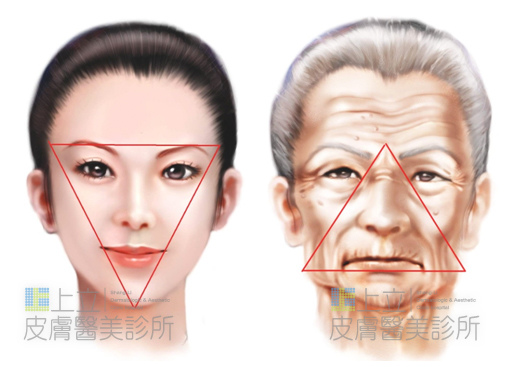 液態拉皮上立提新Ellansé 洢蓮絲聚己內酯少女針PolycaprolactonePCL膠原增生劑易麗適依戀詩3D聚左旋乳酸童顏針舒顏萃Sculptra晶亮瓷(微晶瓷)林上立上立皮膚科02.jpg