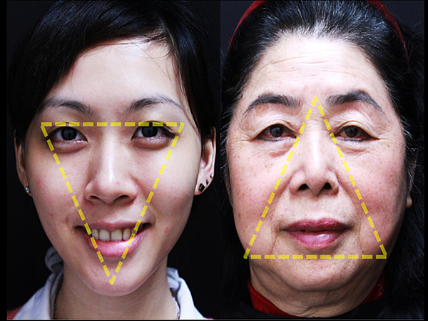 液態拉皮上立提新Ellansé 洢蓮絲聚己內酯少女針PolycaprolactonePCL膠原增生劑易麗適依戀詩3D聚左旋乳酸童顏針舒顏萃Sculptra晶亮瓷(微晶瓷)林上立上立皮膚科03.png 液態拉皮上立提新Ellansé 洢蓮絲聚己內酯少女針PolycaprolactonePCL膠原增生劑易麗適依戀詩3D聚左旋乳酸童顏針舒顏萃Sculptra晶亮瓷(微晶瓷)林上立上立皮膚科03.png