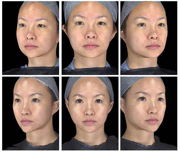 液態拉皮上立提新Ellansé 洢蓮絲聚己內酯少女針PolycaprolactonePCL膠原增生劑易麗適依戀詩3D聚左旋乳酸童顏針舒顏萃Sculptra晶亮瓷(微晶瓷)林上立上立皮膚科05.jpg 液態拉皮上立提新Ellansé 洢蓮絲聚己內酯少女針PolycaprolactonePCL膠原增生劑易麗適依戀詩3D聚左旋乳酸童顏針舒顏萃Sculptra晶亮瓷(微晶瓷)林上立上立皮膚科05.jpg