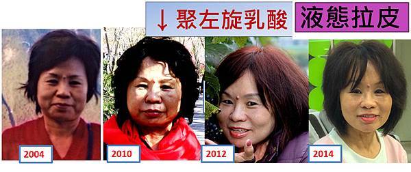 液態拉皮上立提新Ellansé 洢蓮絲聚己內酯少女針PolycaprolactonePCL膠原增生劑易麗適依戀詩3D聚左旋乳酸童顏針舒顏萃Sculptra晶亮瓷(微晶瓷)林上立上立皮膚科06.jpg 液態拉皮上立提新Ellansé 洢蓮絲聚己內酯少女針PolycaprolactonePCL膠原增生劑易麗適依戀詩3D聚左旋乳酸童顏針舒顏萃Sculptra晶亮瓷(微晶瓷)林上立上立皮膚科06.jpg