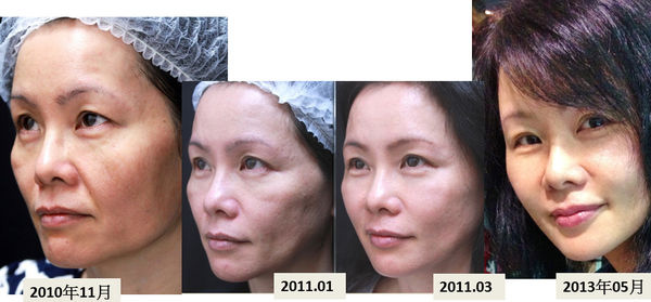 液態拉皮上立提新Ellansé 洢蓮絲聚己內酯少女針PolycaprolactonePCL膠原增生劑易麗適依戀詩3D聚左旋乳酸童顏針舒顏萃Sculptra晶亮瓷(微晶瓷)林上立上立皮膚科07.jpg 液態拉皮上立提新Ellansé 洢蓮絲聚己內酯少女針PolycaprolactonePCL膠原增生劑易麗適依戀詩3D聚左旋乳酸童顏針舒顏萃Sculptra晶亮瓷(微晶瓷)林上立上立皮膚科07.jpg