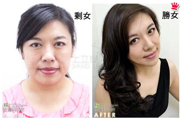 液態拉皮上立提新Ellansé 洢蓮絲聚己內酯少女針PolycaprolactonePCL膠原增生劑易麗適依戀詩3D聚左旋乳酸童顏針舒顏萃Sculptra晶亮瓷(微晶瓷)林上立上立皮膚科08.jpg 液態拉皮上立提新Ellansé 洢蓮絲聚己內酯少女針PolycaprolactonePCL膠原增生劑易麗適依戀詩3D聚左旋乳酸童顏針舒顏萃Sculptra晶亮瓷(微晶瓷)林上立上立皮膚科08.jpg