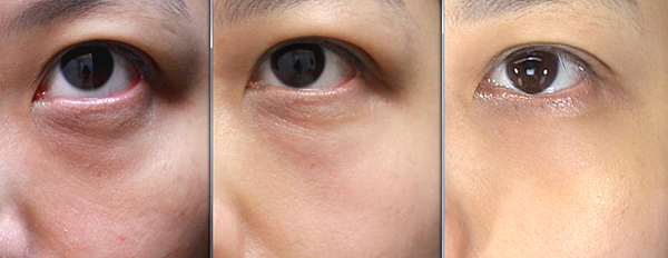 液態拉皮上立提新Ellansé 洢蓮絲聚己內酯少女針PolycaprolactonePCL膠原增生劑易麗適依戀詩3D聚左旋乳酸童顏針舒顏萃Sculptra晶亮瓷(微晶瓷)林上立上立皮膚科10.png 液態拉皮上立提新Ellansé 洢蓮絲聚己內酯少女針PolycaprolactonePCL膠原增生劑易麗適依戀詩3D聚左旋乳酸童顏針舒顏萃Sculptra晶亮瓷(微晶瓷)林上立上立皮膚科10.png