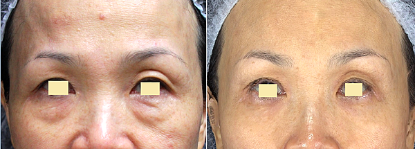 液態拉皮上立提新Ellansé 洢蓮絲聚己內酯少女針PolycaprolactonePCL膠原增生劑易麗適依戀詩3D聚左旋乳酸童顏針舒顏萃Sculptra晶亮瓷(微晶瓷)林上立上立皮膚科12.png 液態拉皮上立提新Ellansé 洢蓮絲聚己內酯少女針PolycaprolactonePCL膠原增生劑易麗適依戀詩3D聚左旋乳酸童顏針舒顏萃Sculptra晶亮瓷(微晶瓷)林上立上立皮膚科12.png