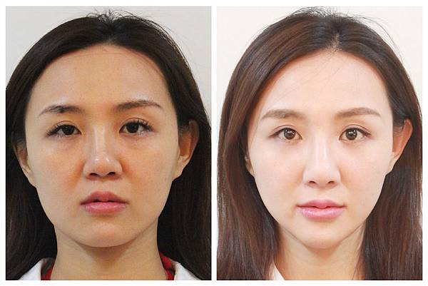 液態拉皮上立提新Ellansé 洢蓮絲聚己內酯少女針PolycaprolactonePCL膠原增生劑易麗適依戀詩3D聚左旋乳酸童顏針舒顏萃Sculptra晶亮瓷(微晶瓷)林上立上立皮膚科13.jpg 液態拉皮上立提新Ellansé 洢蓮絲聚己內酯少女針PolycaprolactonePCL膠原增生劑易麗適依戀詩3D聚左旋乳酸童顏針舒顏萃Sculptra晶亮瓷(微晶瓷)林上立上立皮膚科13.jpg