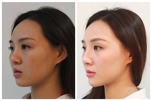 液態拉皮上立提新Ellansé 洢蓮絲聚己內酯少女針PolycaprolactonePCL膠原增生劑易麗適依戀詩3D聚左旋乳酸童顏針舒顏萃Sculptra晶亮瓷(微晶瓷)林上立上立皮膚科14.jpg 液態拉皮上立提新Ellansé 洢蓮絲聚己內酯少女針PolycaprolactonePCL膠原增生劑易麗適依戀詩3D聚左旋乳酸童顏針舒顏萃Sculptra晶亮瓷(微晶瓷)林上立上立皮膚科14.jpg