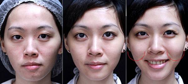 液態拉皮上立提新Ellansé 洢蓮絲聚己內酯少女針PolycaprolactonePCL膠原增生劑易麗適依戀詩3D聚左旋乳酸童顏針舒顏萃Sculptra晶亮瓷(微晶瓷)林上立上立皮膚科15.jpg 液態拉皮上立提新Ellansé 洢蓮絲聚己內酯少女針PolycaprolactonePCL膠原增生劑易麗適依戀詩3D聚左旋乳酸童顏針舒顏萃Sculptra晶亮瓷(微晶瓷)林上立上立皮膚科15.jpg