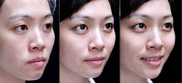 液態拉皮上立提新Ellansé 洢蓮絲聚己內酯少女針PolycaprolactonePCL膠原增生劑易麗適依戀詩3D聚左旋乳酸童顏針舒顏萃Sculptra晶亮瓷(微晶瓷)林上立上立皮膚科16.jpg 液態拉皮上立提新Ellansé 洢蓮絲聚己內酯少女針PolycaprolactonePCL膠原增生劑易麗適依戀詩3D聚左旋乳酸童顏針舒顏萃Sculptra晶亮瓷(微晶瓷)林上立上立皮膚科16.jpg