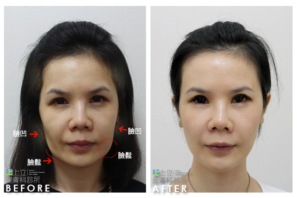 新Ellansé 洢蓮絲少女針PolycaprolactonePCL膠原增生劑洢蓮絲上立皮膚科林上立洢蓮絲3D聚左旋乳酸晶亮瓷微晶瓷隆鼻墊下巴拉提上立皮膚科 費用 林上立 價格 林上立 評價 液態拉皮上立提 液態拉皮 推薦液態拉皮Ellanse洢蓮絲易麗適依戀詩03.jpg 新Ellansé 洢蓮絲少女針PolycaprolactonePCL膠原增生劑洢蓮絲上立皮膚科林上立洢蓮絲3D聚左旋乳酸晶亮瓷微晶瓷隆鼻墊下巴拉提上立皮膚科 費用 林上立 價格 林上立 評價 液態拉皮上立提 液態拉皮 推薦液態拉皮Ellanse洢蓮絲易麗適依戀詩03.jpg