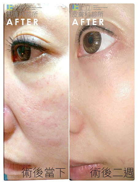 PicoSure蜂巢皮秒除皺雷射 除皺雷射 蜂巢皮秒機械光755雷射 淨膚雷射蜂巢瞬效透鏡 蜂巢皮秒機械光雷射PicoSure皮秒雷射雀斑曬斑 細紋眼下細紋毛孔粗大飛梭雷射縮毛孔淨膚雷射皮秒雷射價格皮秒雷射價錢皮秒雷射凹洞皮秒雷射除斑皮秒雷射刺青皮秒機械光雷射755蜂巢皮秒蜂巢皮秒雷射06.jpg PicoSure蜂巢皮秒除皺雷射 除皺雷射 蜂巢皮秒機械光755雷射 淨膚雷射蜂巢瞬效透鏡 蜂巢皮秒機械光雷射PicoSure皮秒雷射雀斑曬斑 細紋眼下細紋毛孔粗大飛梭雷射縮毛孔淨膚雷射皮秒雷射價格皮秒雷射價錢皮秒雷射凹洞皮秒雷射除斑皮秒雷射刺青皮秒機械光雷射755蜂巢皮秒蜂巢皮秒雷射06.jpg