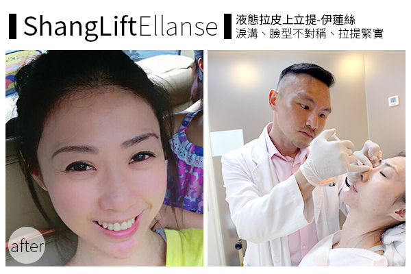 Ellanse洢蓮絲易麗適依戀詩新Ellansé 洢蓮絲少女針PolycaprolactonePCL膠原增生劑洢蓮絲上立皮膚科林上立洢蓮絲上立皮膚科 費用 林上立 價格 林上立 評價 液態拉皮上立提 液態拉皮 推薦液態拉皮聚己內酯.jpg Ellanse洢蓮絲易麗適依戀詩新Ellansé 洢蓮絲少女針PolycaprolactonePCL膠原增生劑洢蓮絲上立皮膚科林上立洢蓮絲上立皮膚科 費用 林上立 價格 林上立 評價 液態拉皮上立提 液態拉皮 推薦液態拉皮聚己內酯.jpg