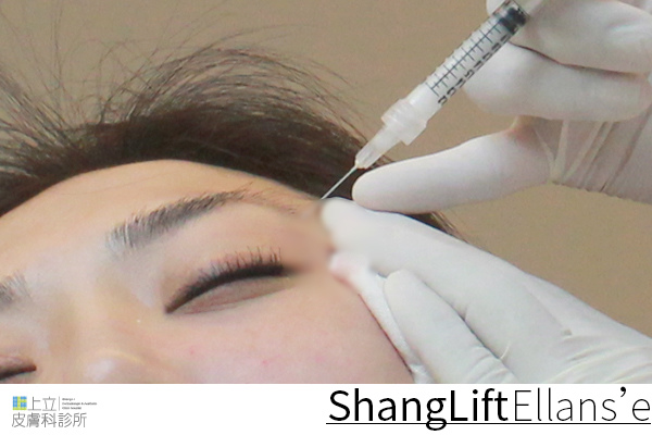 Ellanse洢蓮絲易麗適依戀詩新Ellansé 洢蓮絲少女針PolycaprolactonePCL膠原增生劑洢蓮絲上立皮膚科林上立洢蓮絲上立皮膚科 費用 林上立 價格 林上立 評價 液態拉皮上立提 液態拉皮 推薦液態拉皮聚己內酯03.jpg Ellanse洢蓮絲易麗適依戀詩新Ellansé 洢蓮絲少女針PolycaprolactonePCL膠原增生劑洢蓮絲上立皮膚科林上立洢蓮絲上立皮膚科 費用 林上立 價格 林上立 評價 液態拉皮上立提 液態拉皮 推薦液態拉皮聚己內酯03.jpg