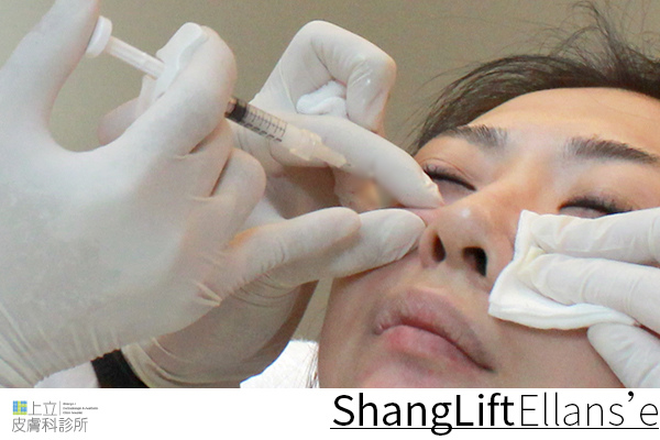 Ellanse洢蓮絲易麗適依戀詩新Ellansé 洢蓮絲少女針PolycaprolactonePCL膠原增生劑洢蓮絲上立皮膚科林上立洢蓮絲上立皮膚科 費用 林上立 價格 林上立 評價 液態拉皮上立提 液態拉皮 推薦液態拉皮聚己內酯04.jpg Ellanse洢蓮絲易麗適依戀詩新Ellansé 洢蓮絲少女針PolycaprolactonePCL膠原增生劑洢蓮絲上立皮膚科林上立洢蓮絲上立皮膚科 費用 林上立 價格 林上立 評價 液態拉皮上立提 液態拉皮 推薦液態拉皮聚己內酯04.jpg