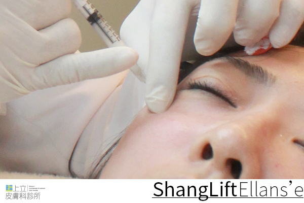 Ellanse洢蓮絲易麗適依戀詩新Ellansé 洢蓮絲少女針PolycaprolactonePCL膠原增生劑洢蓮絲上立皮膚科林上立洢蓮絲上立皮膚科 費用 林上立 價格 林上立 評價 液態拉皮上立提 液態拉皮 推薦液態拉皮聚己內酯05.jpg Ellanse洢蓮絲易麗適依戀詩新Ellansé 洢蓮絲少女針PolycaprolactonePCL膠原增生劑洢蓮絲上立皮膚科林上立洢蓮絲上立皮膚科 費用 林上立 價格 林上立 評價 液態拉皮上立提 液態拉皮 推薦液態拉皮聚己內酯05.jpg
