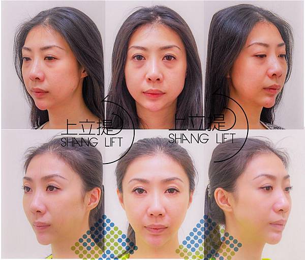 Ellanse洢蓮絲易麗適依戀詩新Ellansé 洢蓮絲少女針PolycaprolactonePCL膠原增生劑洢蓮絲上立皮膚科林上立洢蓮絲上立皮膚科 費用 林上立 價格 林上立 評價 液態拉皮上立提 液態拉皮 推薦液態拉皮聚己內酯09.jpg Ellanse洢蓮絲易麗適依戀詩新Ellansé 洢蓮絲少女針PolycaprolactonePCL膠原增生劑洢蓮絲上立皮膚科林上立洢蓮絲上立皮膚科 費用 林上立 價格 林上立 評價 液態拉皮上立提 液態拉皮 推薦液態拉皮聚己內酯09.jpg