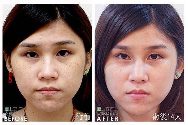 PicoSure蜂巢皮秒除皺雷射 除皺雷射 蜂巢皮秒機械光755雷射 淨膚雷射蜂巢瞬效透鏡 蜂巢皮秒機械光雷射PicoSure皮秒雷射雀斑曬斑 細紋眼下細紋毛孔粗大飛梭雷射縮毛孔淨膚雷射皮秒雷射價格皮秒雷射價錢皮秒雷射凹洞皮秒雷射除斑皮秒雷射刺青11.jpg PicoSure蜂巢皮秒除皺雷射 除皺雷射 蜂巢皮秒機械光755雷射 淨膚雷射蜂巢瞬效透鏡 蜂巢皮秒機械光雷射PicoSure皮秒雷射雀斑曬斑 細紋眼下細紋毛孔粗大飛梭雷射縮毛孔淨膚雷射皮秒雷射價格皮秒雷射價錢皮秒雷射凹洞皮秒雷射除斑皮秒雷射刺青11.jpg